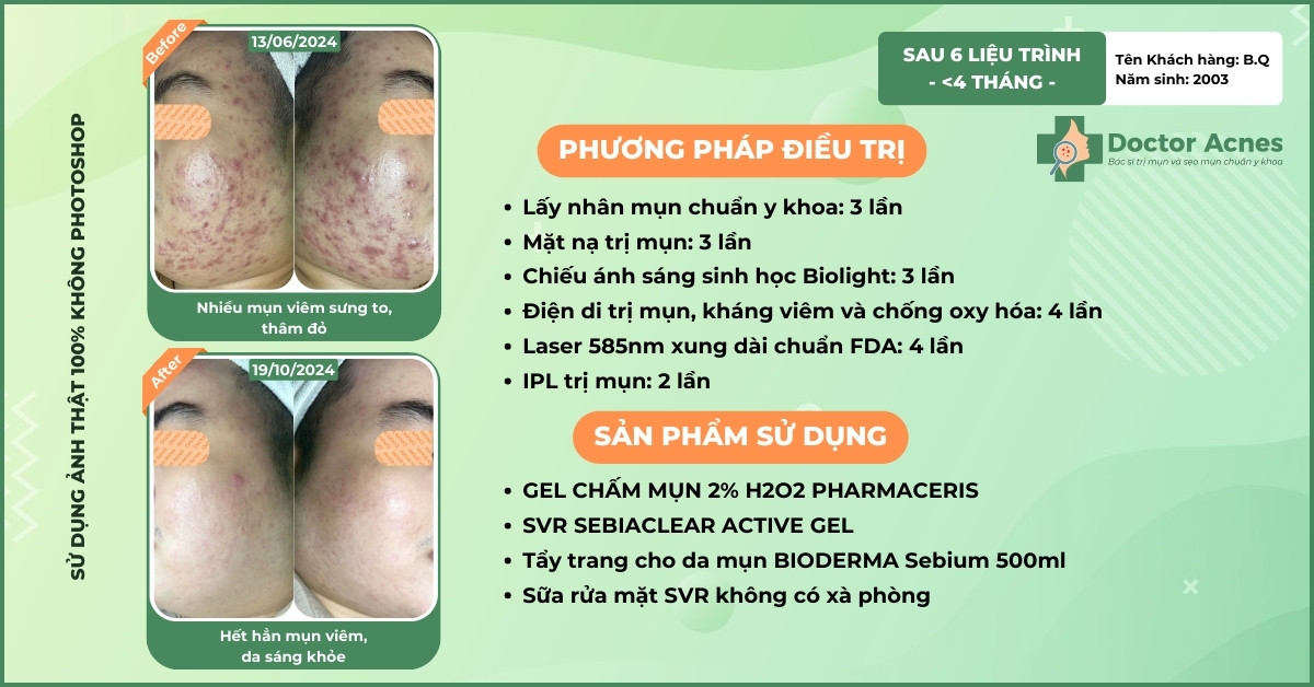 ca lâm sàng trị mụn