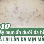 Top 10 cách đẩy mụn ẩn dưới da hiệu quả trả lại làn da mịn màng