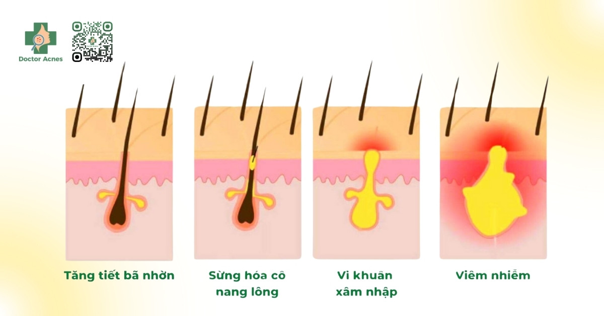 cơ chế bệnh sinh của mụn