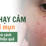 Da nhạy cảm dễ nổi mụn: dấu hiệu và cách chăm sóc hiệu quả