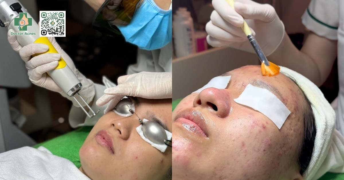 laser peel da trị mụn