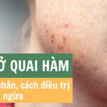 Mụn ở quai hàm: nguyên nhân, cách điều trị và phòng ngừa