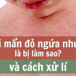 Da nổi mẩn đỏ ngứa như mụn là bị làm sao và cách xử lý