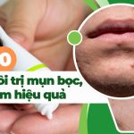 Top 10 thuốc bôi trị mụn bọc hiệu quả nhất hiện nay