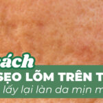 10 cách trị sẹo lõm trên trán giúp lấy lại làn da mịn màng