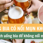 Uống bia có nổi mụn không? Cách uống bia để không nổi mụn