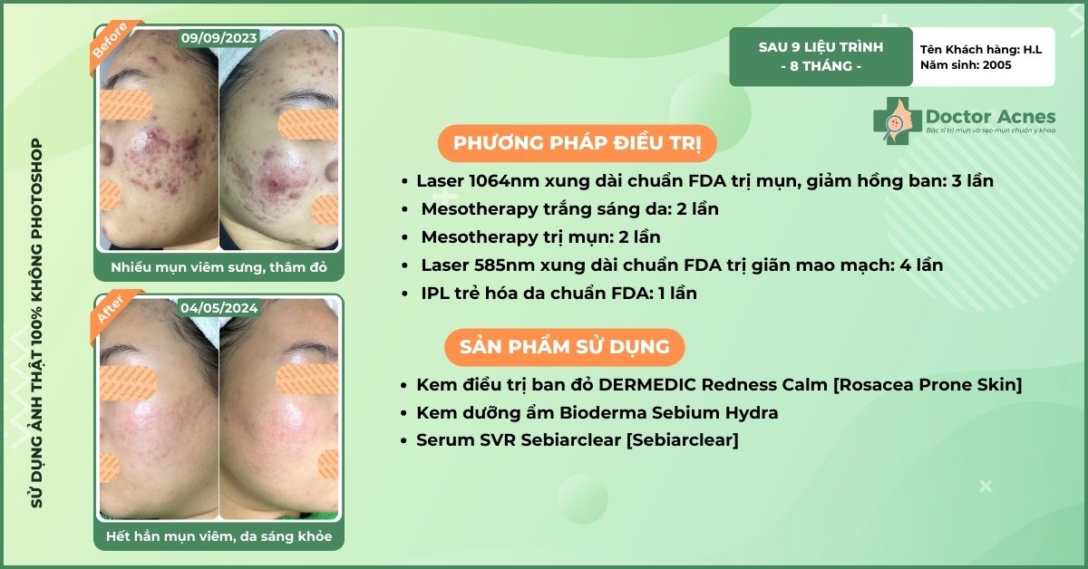 ca lâm sàng trị mụn thâm thành công