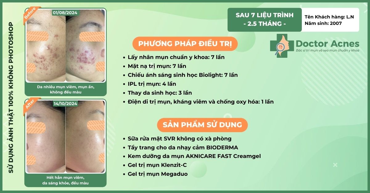 ca lâm sang trị mụn thành công tại doctor acnes