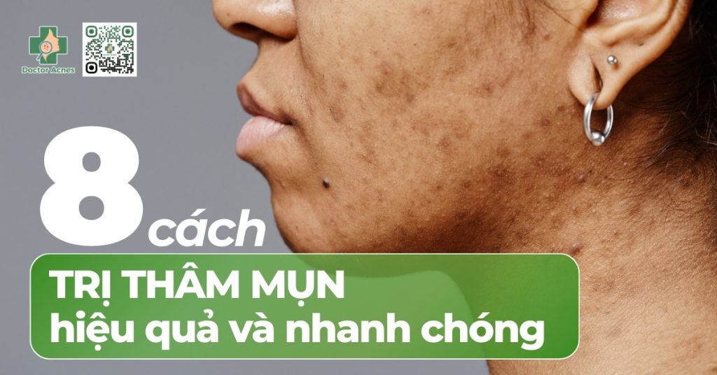 cách trị thâm mụn