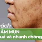 8 cách trị thâm mụn hiệu quả và nhanh chóng