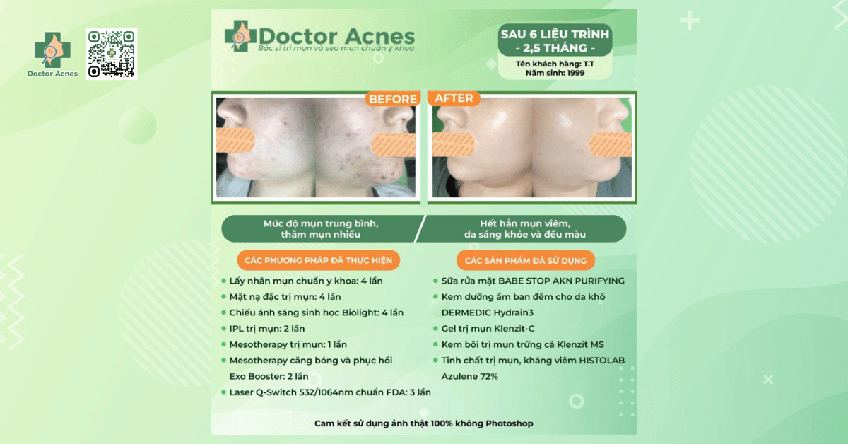 Ca lâm sàng tiêm meso căng bóng thành công tại Doctor Acnes