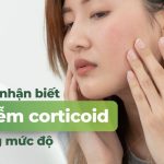 Dấu hiệu nhận biết da nhiễm corticoid theo từng mức độ