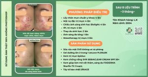 Top 10 kem chấm mụn viêm hiệu quả nhất hiện nay