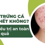 Mụn trứng cá có tự hết không? Cách điều trị an toàn và hiệu quả