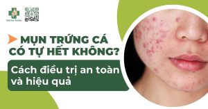 mụn trứng cá có tự hết không