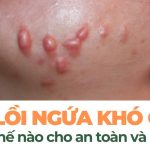 Sẹo lồi ngứa khó chịu: điều trị thế nào cho hiệu quả và an toàn?