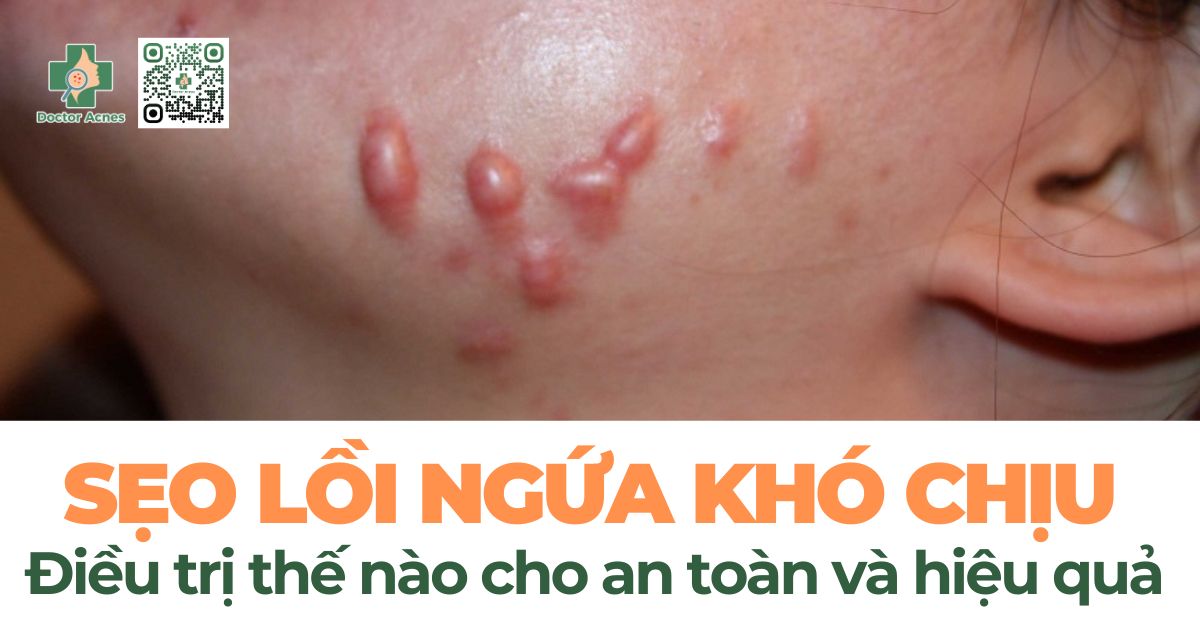 sẹo lồi ngứa khó chịu