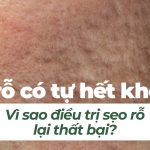 Sẹo rỗ có tự hết không? Vì sao điều trị sẹo rỗ lại thất bại?