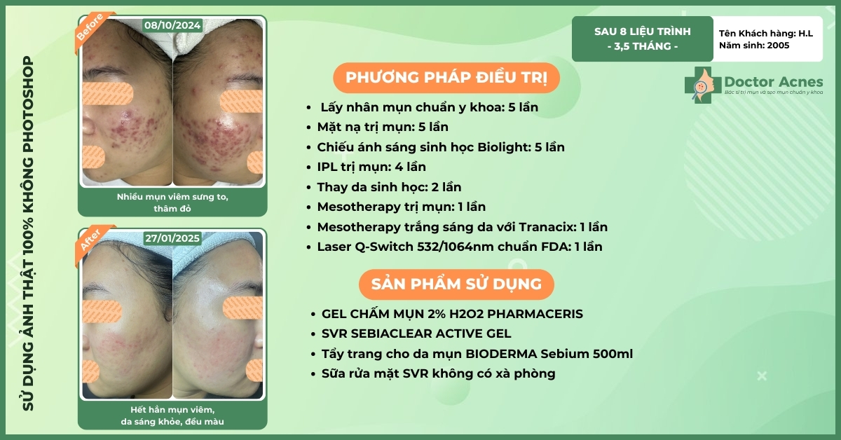 ca lâm sàng điều trị da có quy trình peel