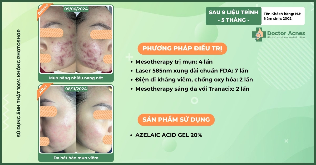 ca lâm sàng điều trị mụn nang tại Phòng khám Doctor Acnes