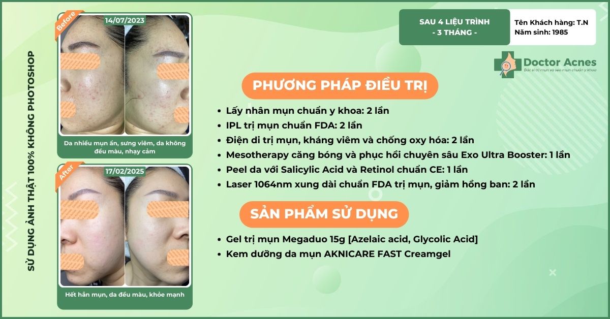 ca lâm sàng điều trị mụn thành công