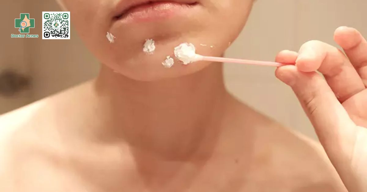 trị mụn bọc bằng aspirin