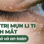 Cách trị mụn li ti quanh mắt hiệu quả và an toàn