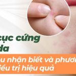 Mụn cục cứng dưới da: dấu hiệu nhận biết và phương pháp điều trị hiệu quả