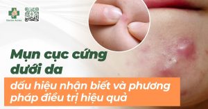 dấu hiệu nhận biết mụn cục cứng dưới da