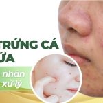 Mụn trứng cá bị ngứa: nguyên nhân và cách xử lý