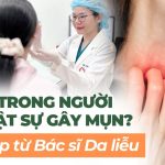 Nóng trong người có thật sự gây mụn? Giải đáp từ Bác sĩ Da liễu