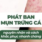 Phát ban mụn trứng cá: nguyên nhân và cách khắc phục nhanh chóng