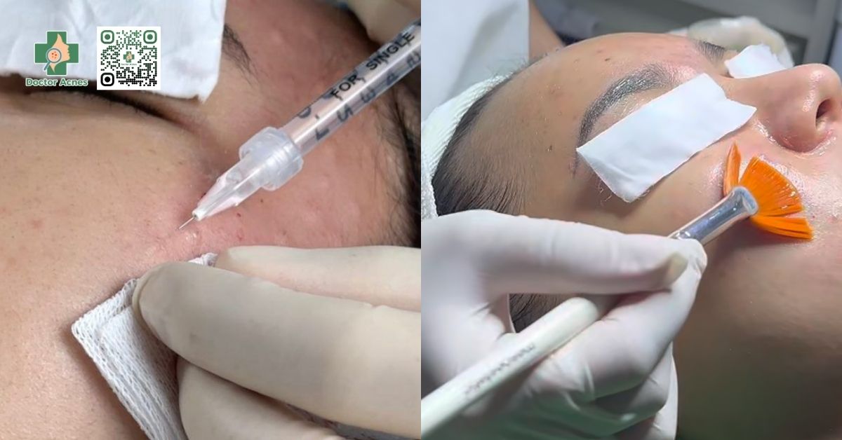 phương pháp điều trị mụn