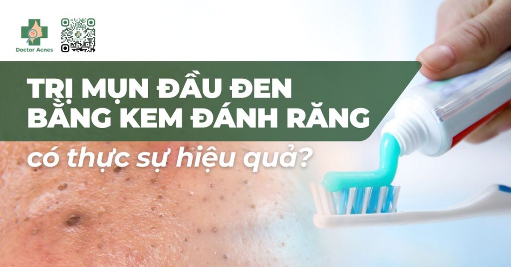 trị mụn đầu đen bằng kem đánh răng