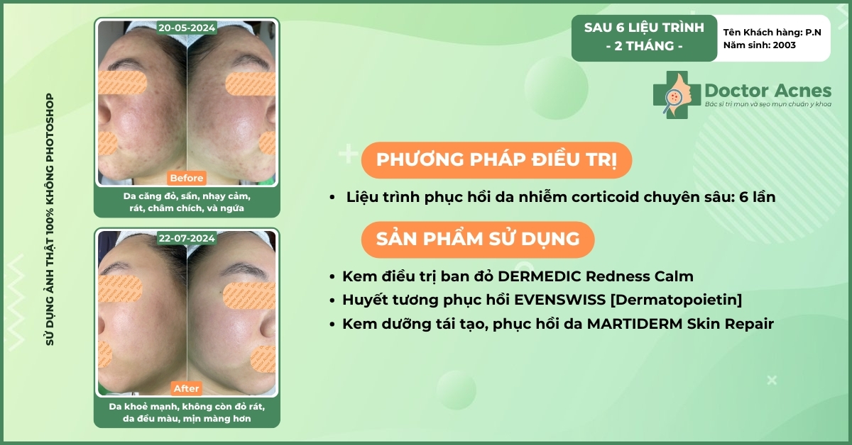 trường hợp nhiễm corticoid nặng