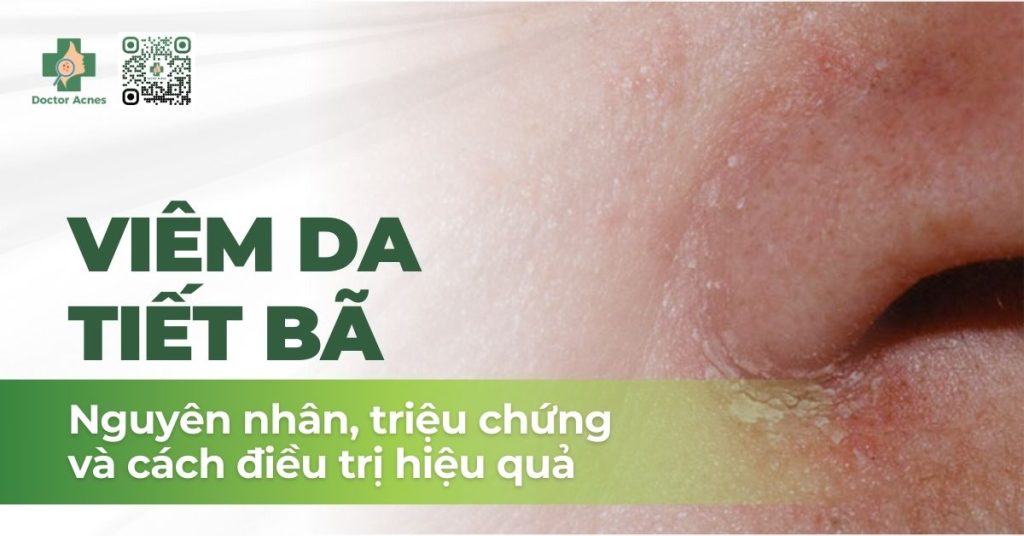 viêm da tiết bã