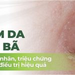Viêm da tiết bã: nguyên nhân, triệu chứng và cách điều trị hiệu quả