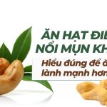 Ăn hạt điều có nổi mụn không? Hiểu đúng để ăn uống lành mạnh hơn