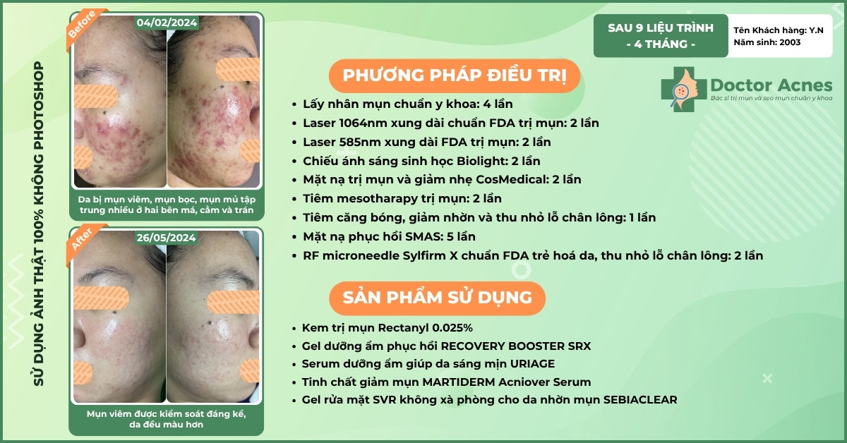cls trị mụn