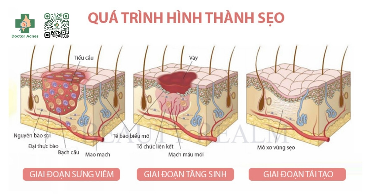 cơ chế hình thành sẹo lồi