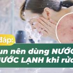 Giải đáp: da mụn nên dùng nước ấm hay nước lạnh khi rửa mặt?