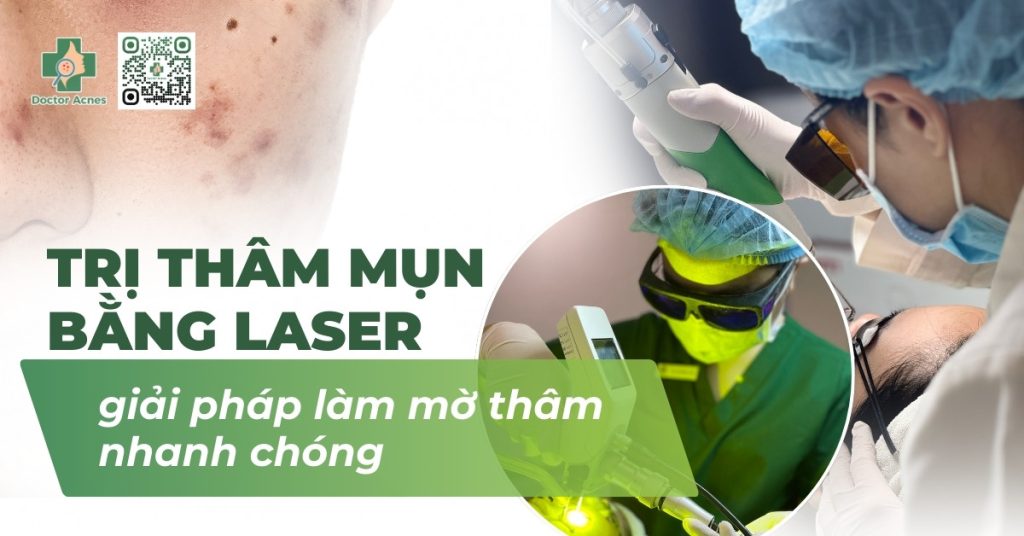 Trị thâm mụn bằng laser