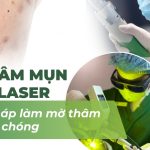 Trị thâm mụn bằng laser: giải pháp làm mờ thâm nhanh chóng