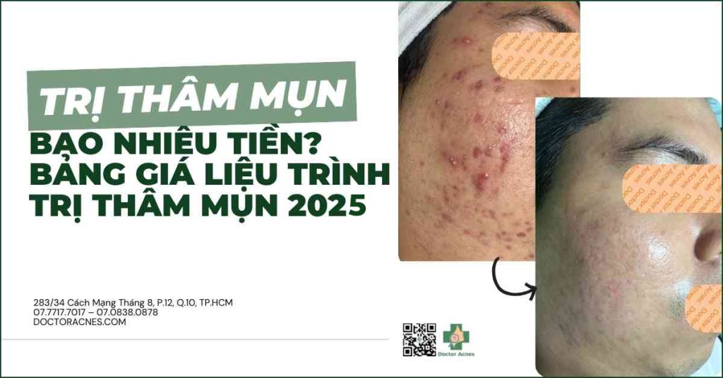 Trị thâm mụn bao nhiêu tiền?