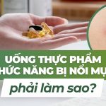 Uống thực phẩm chức năng bị nổi mụn phải làm sao?