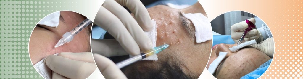Banner LDP meso căng bóng Doctor Acnes