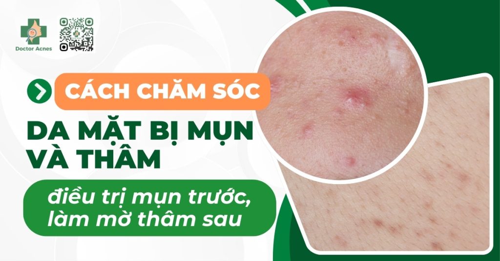 chăm sóc da mụn và thâm
