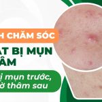 Cách chăm sóc da mặt bị mụn và thâm: điều trị mụn trước, làm mờ thâm sau