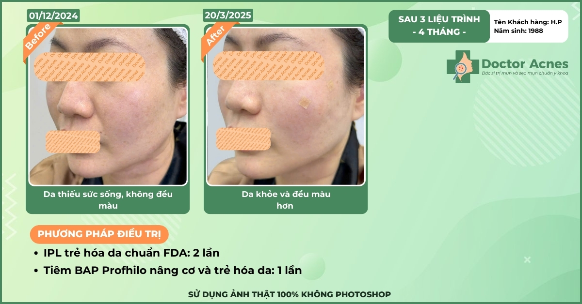 ca lâm sàng nâng cơ trẻ hóa