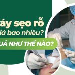 Cắt đáy sẹo rỗ giá bao nhiêu và hiệu quả như thế nào?